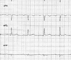 derivazioni aVR avL, aVF : notare PR ai limiti di 5 quadrati piccoli, cioè 0,2 sec.