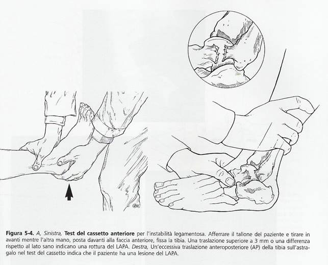 distorsione alla caviglia