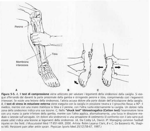 distorsione alla caviglia